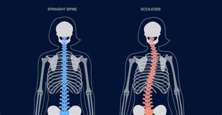 "Scoliosis" | Buy, Play and Listen